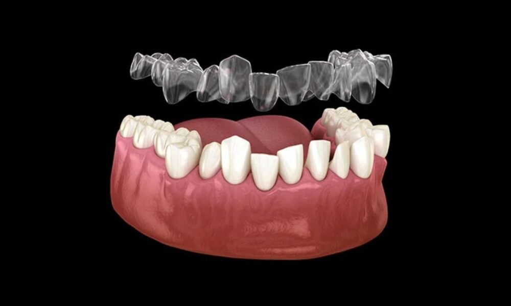 Teeth Aligners